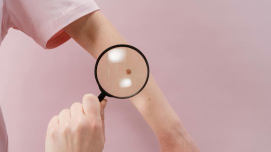 Profilaktyka czerniaka w powiecie ostrowskim. Darmowe badania dla 175 mieszkańców